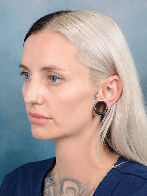 Rhinoplasty Before & After Gallery - Patient 111134285 - Image 5