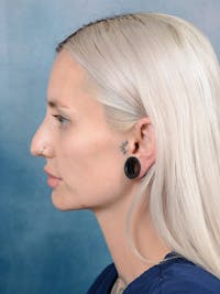 Rhinoplasty Before & After Gallery - Patient 111134285 - Image 1
