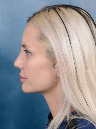 Rhinoplasty Before & After Gallery - Patient 111134285 - Image 2
