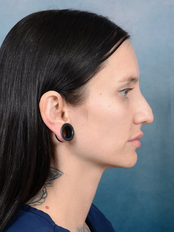 Rhinoplasty Before & After Gallery - Patient 111134285 - Image 9