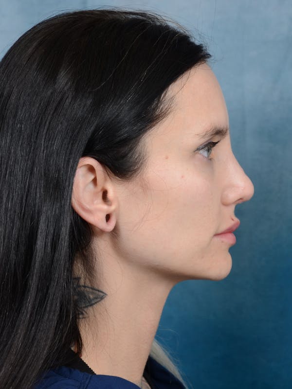 Rhinoplasty Before & After Gallery - Patient 111134285 - Image 10