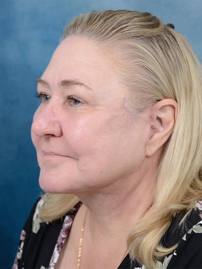 Deep Plane Facelift Before & After Gallery - Patient 112967627 - Image 2