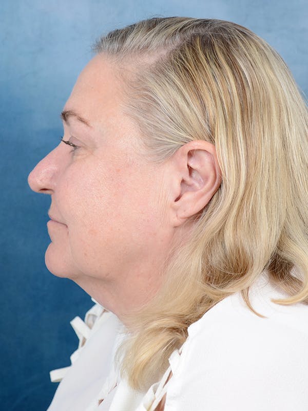 Deep Plane Facelift Before & After Gallery - Patient 112967627 - Image 5
