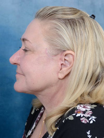 Deep Plane Facelift Before & After Gallery - Patient 112967627 - Image 6