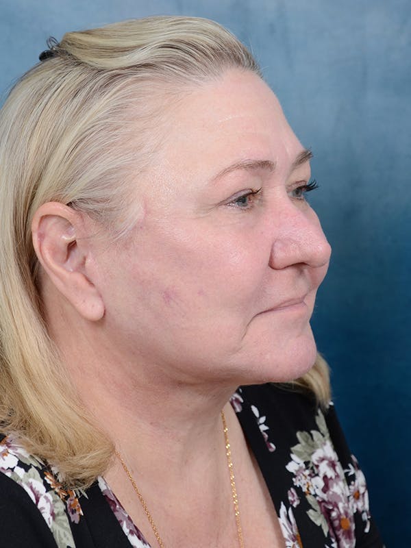 Deep Plane Facelift Before & After Gallery - Patient 112967627 - Image 8