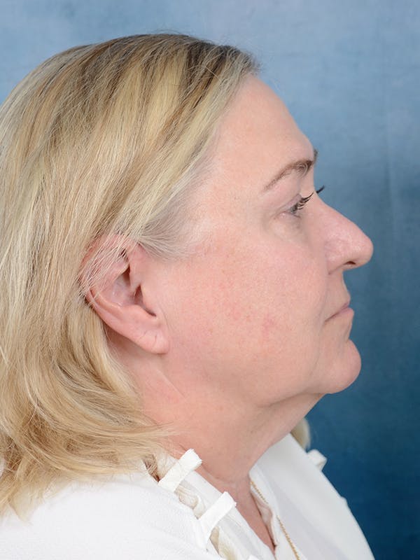 Deep Plane Facelift Before & After Gallery - Patient 112967627 - Image 9