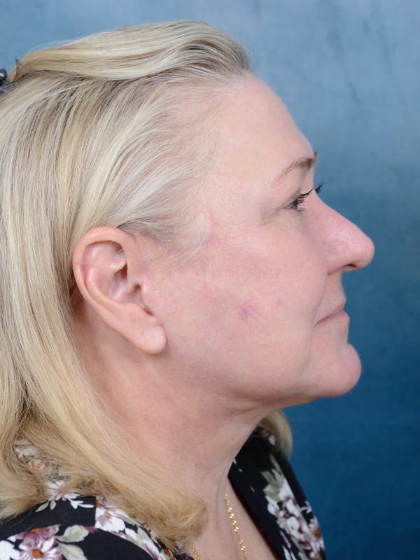Deep Plane Facelift Before & After Gallery - Patient 112967627 - Image 10