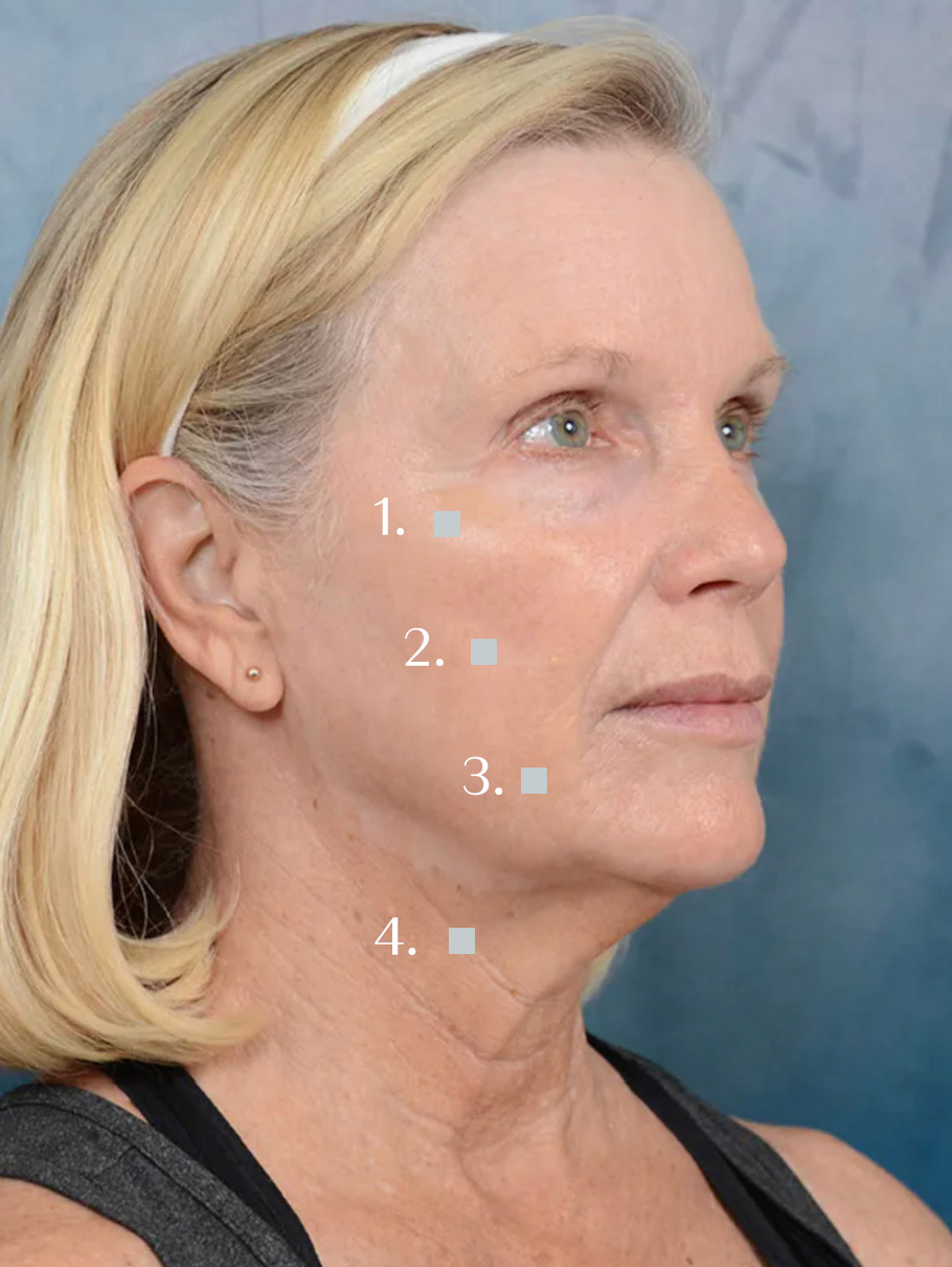an image showing different ligament points on a patients face