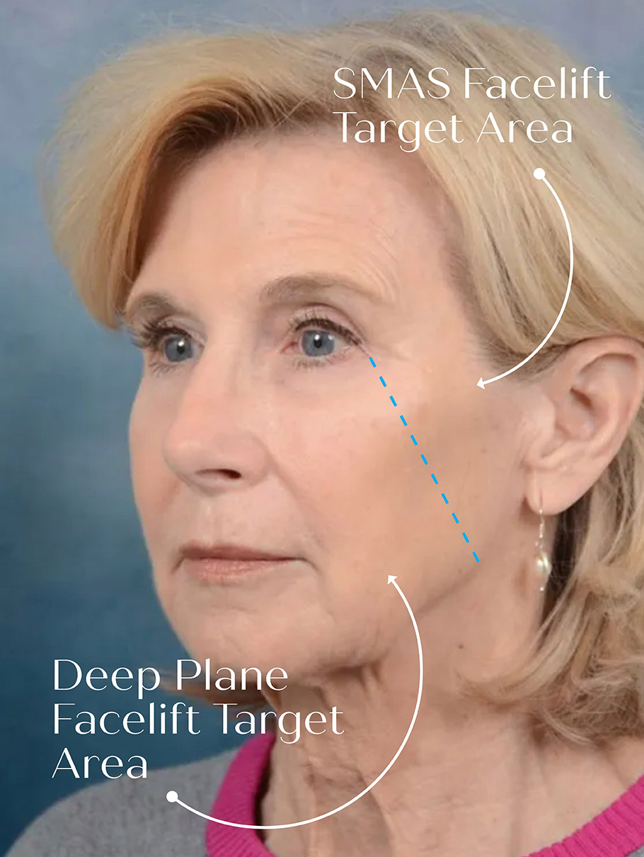 an image showing targeted areas for a facelift