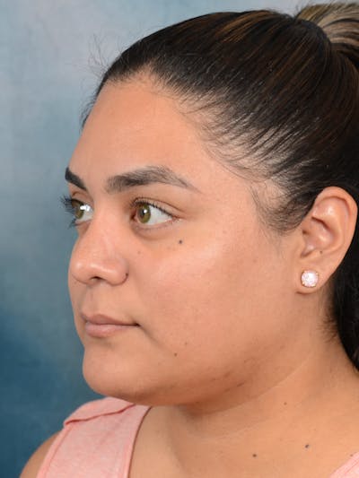 Rhinoplasty Before & After Gallery - Patient 113140259 - Image 6
