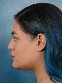 Rhinoplasty Before & After Gallery - Patient 113140259 - Image 1