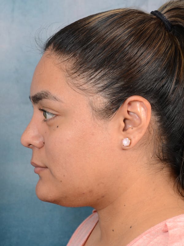 Rhinoplasty Before & After Gallery - Patient 113140259 - Image 2