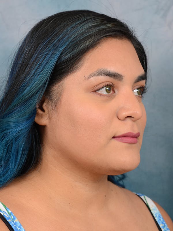 Rhinoplasty Before & After Gallery - Patient 113140259 - Image 7