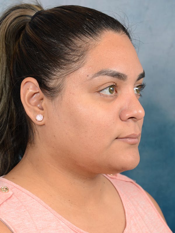 Rhinoplasty Before & After Gallery - Patient 113140259 - Image 8