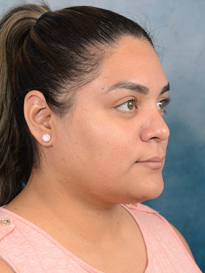 Rhinoplasty Before & After Gallery - Patient 113140259 - Image 8