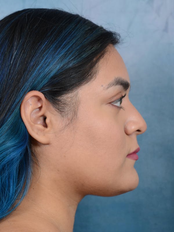 Rhinoplasty Before & After Gallery - Patient 113140259 - Image 9