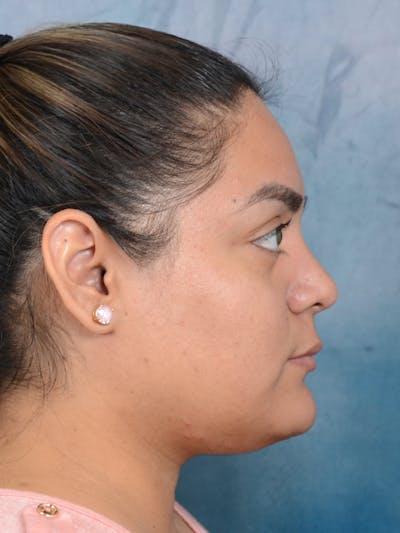 Rhinoplasty Before & After Gallery - Patient 113140259 - Image 10