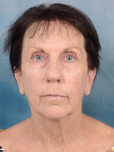 Laser Skin Resurfacing Before & After Gallery - Patient 113140323 - Image 1