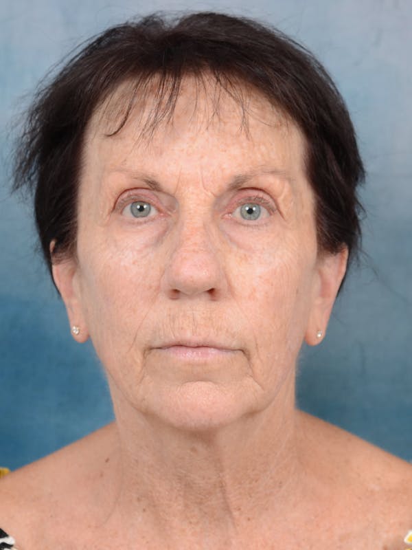 Deep Plane Facelift Before & After Gallery - Patient 113140297 - Image 3