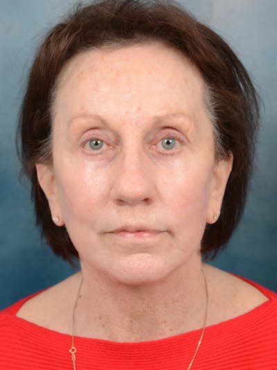 Deep Plane Facelift Before & After Gallery - Patient 113140297 - Image 4