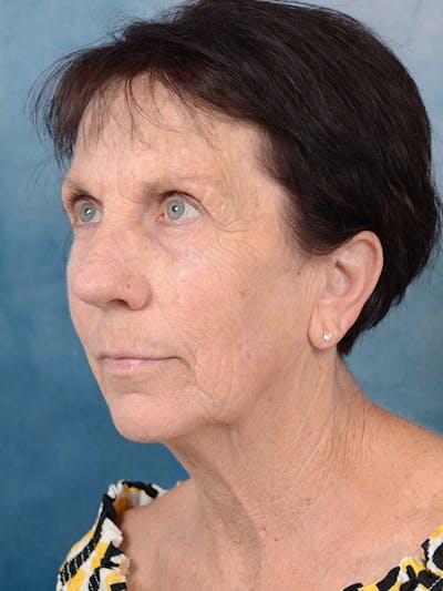 Deep Plane Facelift Before & After Gallery - Patient 113140297 - Image 1
