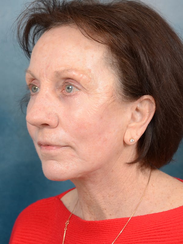 Laser Skin Resurfacing Before & After Gallery - Patient 113140323 - Image 4