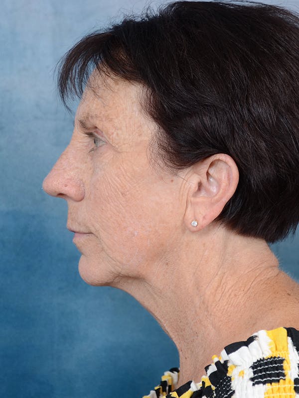 Deep Plane Facelift Before & After Gallery - Patient 113140297 - Image 5