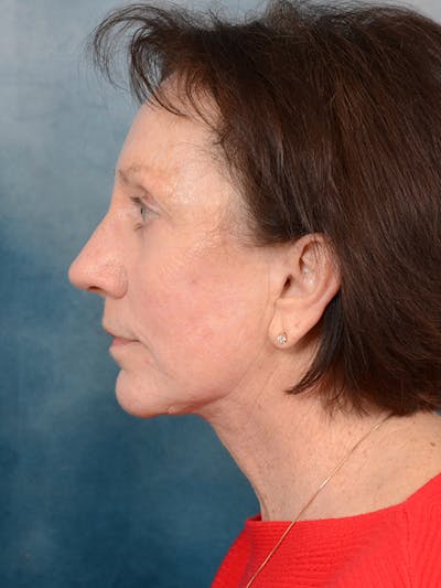 Deep Plane Facelift Before & After Gallery - Patient 113140297 - Image 6