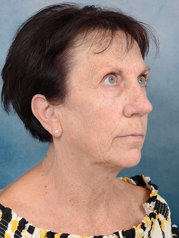 Laser Skin Resurfacing Before & After Gallery - Patient 113140323 - Image 7