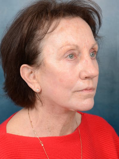 Deep Plane Facelift Before & After Gallery - Patient 113140297 - Image 8