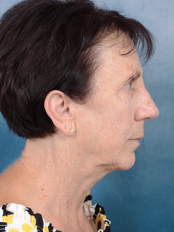 Deep Plane Facelift Before & After Gallery - Patient 113140297 - Image 9