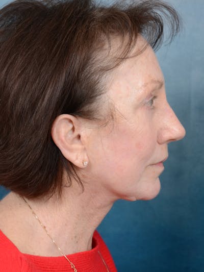 Deep Plane Facelift Before & After Gallery - Patient 113140297 - Image 10