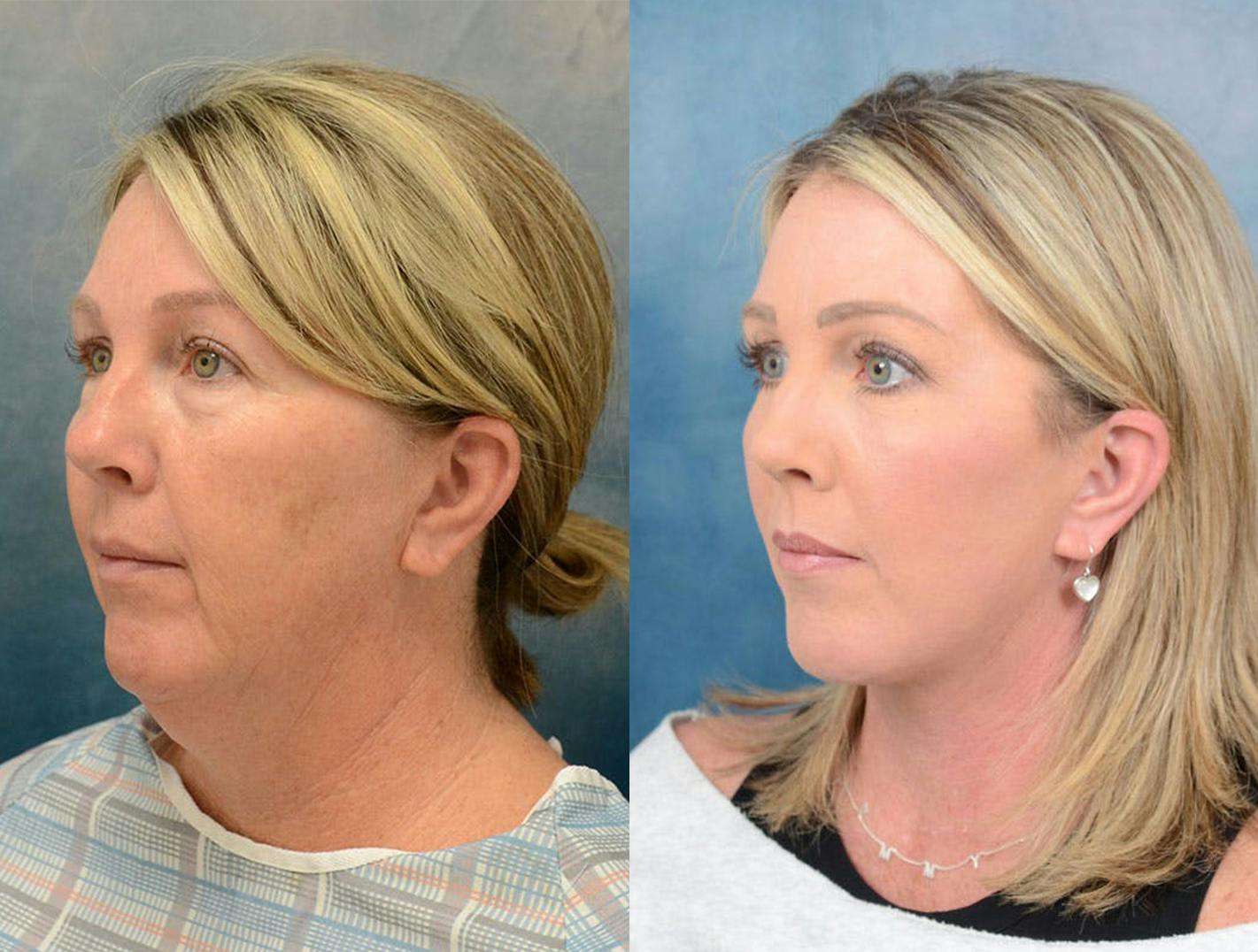 Deep Plane Facelift Scottsdale  Facelift Specialist in Scottsdale