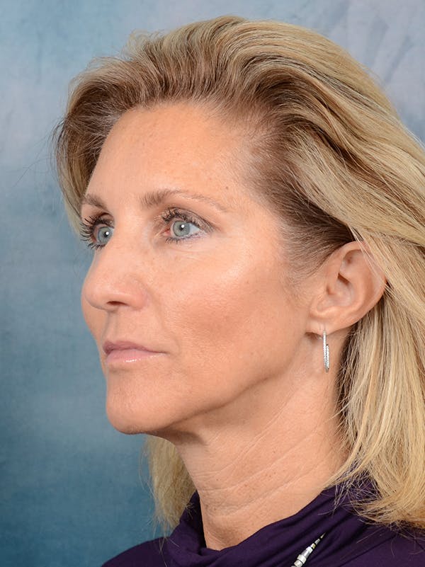 Rhinoplasty Before & After Gallery - Patient 117541718 - Image 3