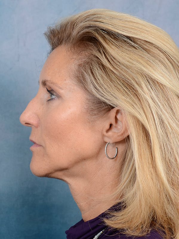 Rhinoplasty Before & After Gallery - Patient 117541718 - Image 1