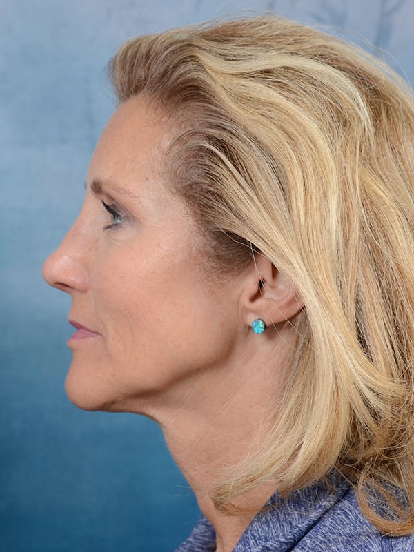 Rhinoplasty Before & After Gallery - Patient 117541718 - Image 2