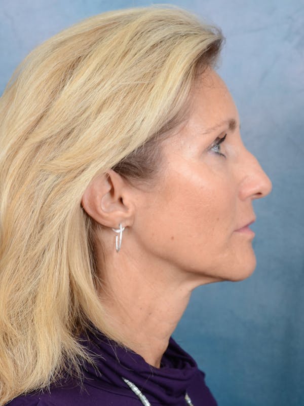 Rhinoplasty Before & After Gallery - Patient 117541718 - Image 9