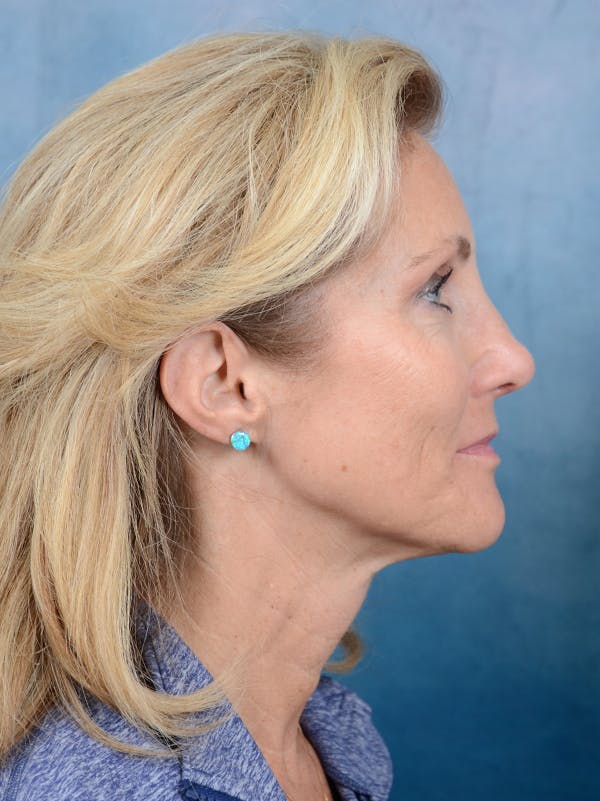 Rhinoplasty Before & After Gallery - Patient 117541718 - Image 10