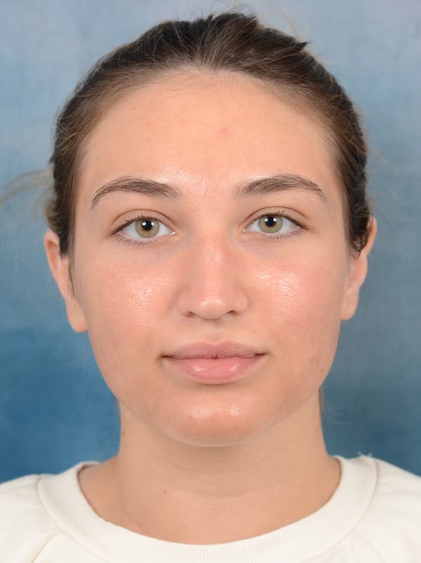 Rhinoplasty Before & After Gallery - Patient 117541719 - Image 5