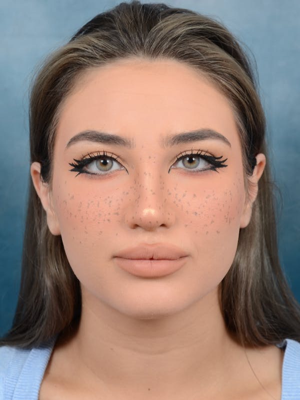 Rhinoplasty Before & After Gallery - Patient 117541719 - Image 6