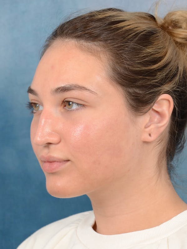 Rhinoplasty Before & After Gallery - Patient 117541719 - Image 3