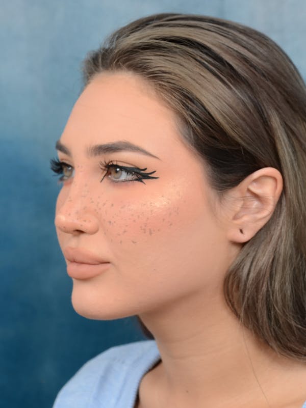 Rhinoplasty Before & After Gallery - Patient 117541719 - Image 4