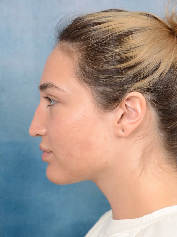 Rhinoplasty Before & After Gallery - Patient 117541719 - Image 1