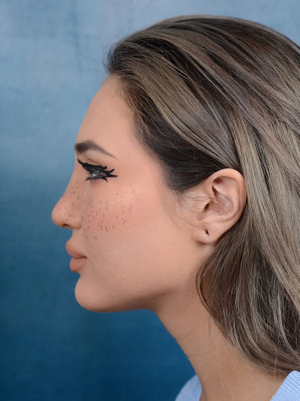 Rhinoplasty Before & After Gallery - Patient 117541719 - Image 2