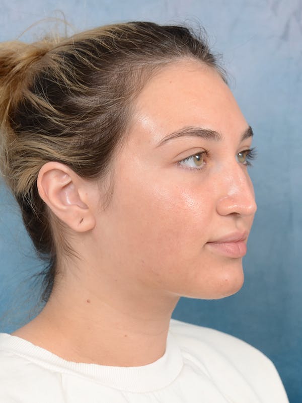 Rhinoplasty Before & After Gallery - Patient 117541719 - Image 7