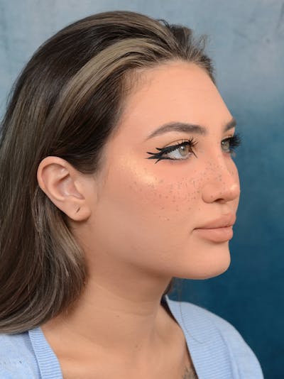 Rhinoplasty Before & After Gallery - Patient 117541719 - Image 8
