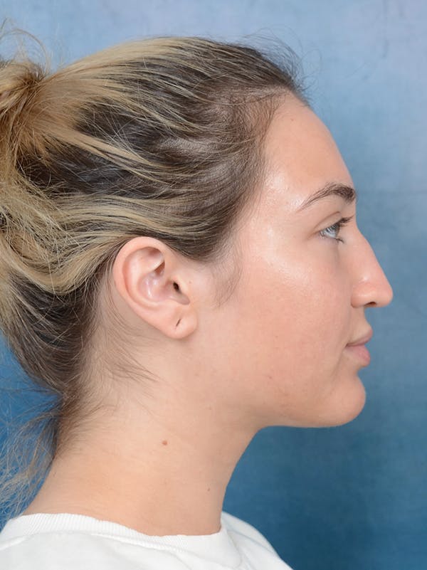 Rhinoplasty Before & After Gallery - Patient 117541719 - Image 9