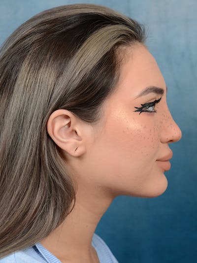 Rhinoplasty Before & After Gallery - Patient 117541719 - Image 10