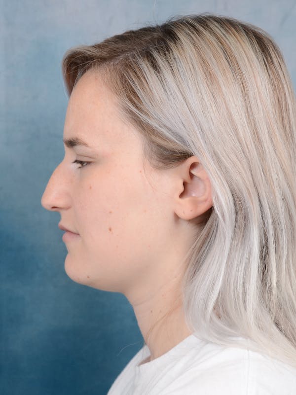 Rhinoplasty Before & After Gallery - Patient 117545553 - Image 1