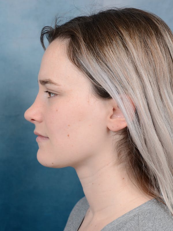 Rhinoplasty Before & After Gallery - Patient 117545553 - Image 2